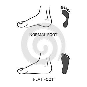 Foot Pathologies, Normal, Flat Foot Isolated On A White Background. Vector Illustration.