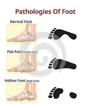 Foot pathologies, Normal, flat and hollow foot - Vector Illustration photo