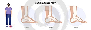 Foot pathologies poster