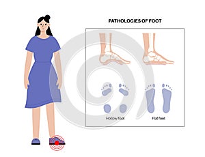 Foot pathologies poster