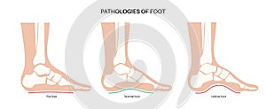 Foot pathologies poster