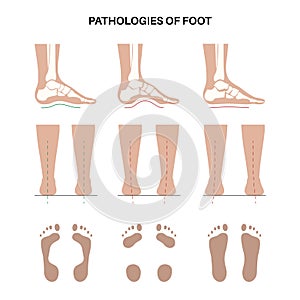 Foot pathologies poster