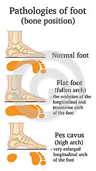 Foot pathology illustration photo