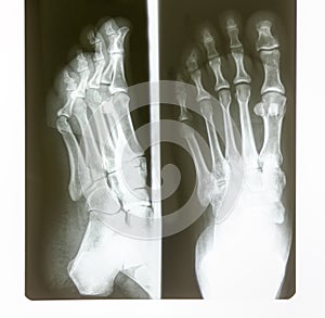 foot radiography black and white film roentgen photo