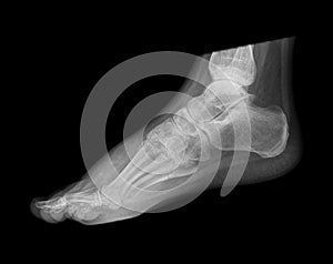 Foot X-ray