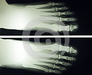 Foot x ray