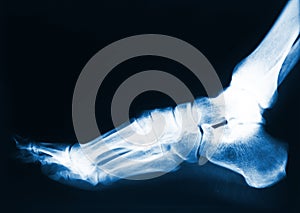 Foot x-ray