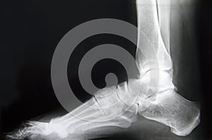 Foot x-ray