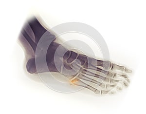 Foot X-ray, avulsion fracture of 5th metatarsal
