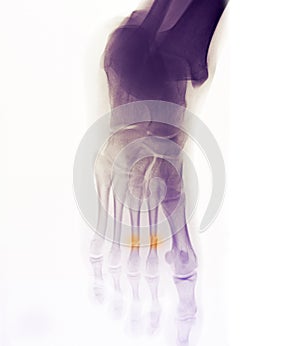 Foot x-ray showing fracture