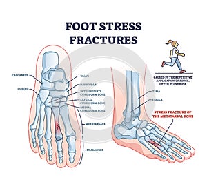 Foot stress fractures as bone cracking trauma or injury outline diagram