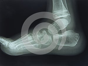 Foot and Toes. Human Leg in the X-ray image