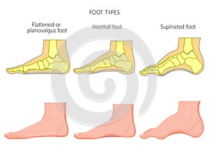 Foot types