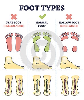 Foot types with flat, normal and hollow feet comparison in outline diagram