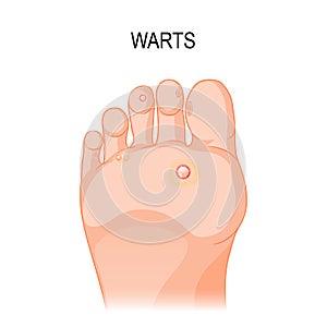 Foot wart