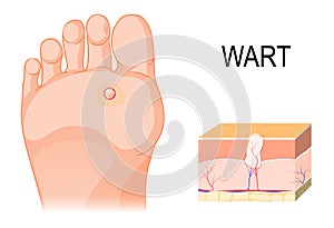 Foot warts on the bottom of soles and toes. Cross section of a c