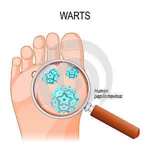 Foot warts. Close-up of HPV