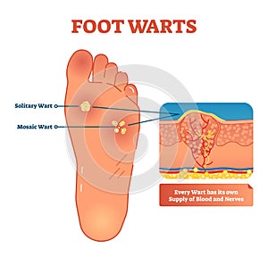 Foot warts vector illustration. Scheme with solitary and mosaic warts. Close-up with wart and its supply of blood and nerves. photo