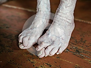 Foot which have bunion hallux valgus problem on floor