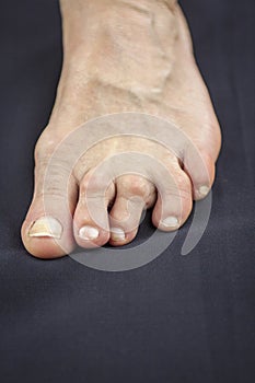 Foot Of Woman Deformed From Rheumatoid Arthritis