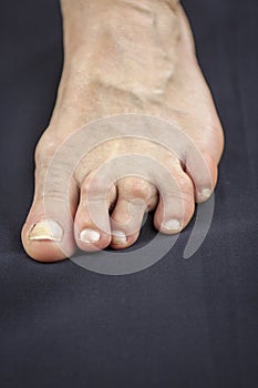 Foot Of Woman Deformed From Rheumatoid Arthritis photo