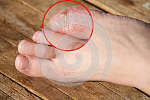 A Foot a woman finger with blisters