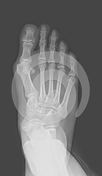 Foot x-ray photo