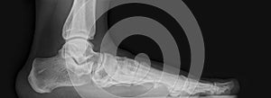 Foot x-ray photo