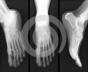 Foot x-ray photo