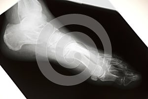 Foot Xray