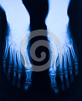 Foot xray