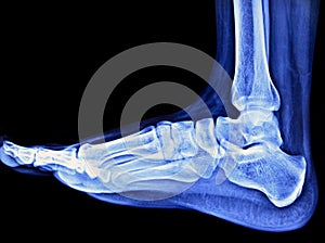 Foot Xray