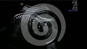 Footage of Blood Flow in the Umbilical Cord in Mothers Womb Ultrasound Scan