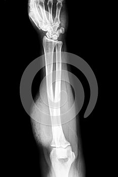 Forearm x-ray photo