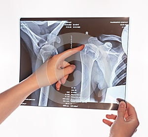 Forefinger pointing to trauma at shoulder, clavicle X-ray image. Acromion, acromial end fracture. Arm injury. Health