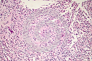 Foreign body granuloma