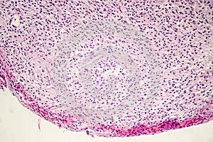 Foreign body granuloma