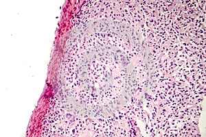 Foreign body granuloma
