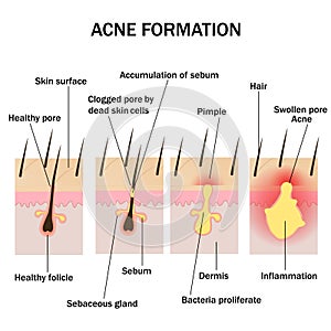 Formation of acne