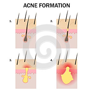 Formation of acne