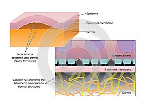 Formation of a blister