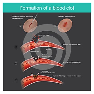 Formation of a blood clot.