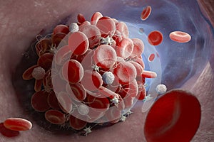 Formation of a blood clot