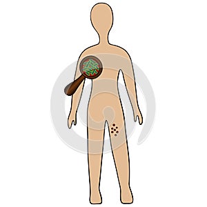The formation of buboes as a result of infection with an acute infectious disease. Vector illustration. Isolated white background. photo
