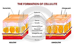 Formación de celulitis. 