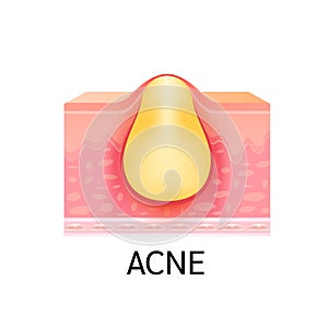 Formation of skin acne or pimple. Anatomy of skin. Medical beauty skin care concept. On a white background.