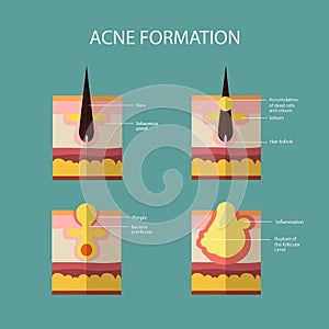Formation of skin acne or pimple. The sebum in the photo