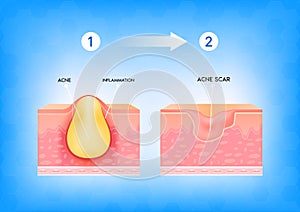Formation of skin acne or pimpleInflamed acne on the skin. Inflammation associated with pimples.