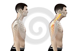 A forward head posture