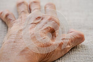 Fossa between index finger and thumb on an old man hand from muscles atrophy